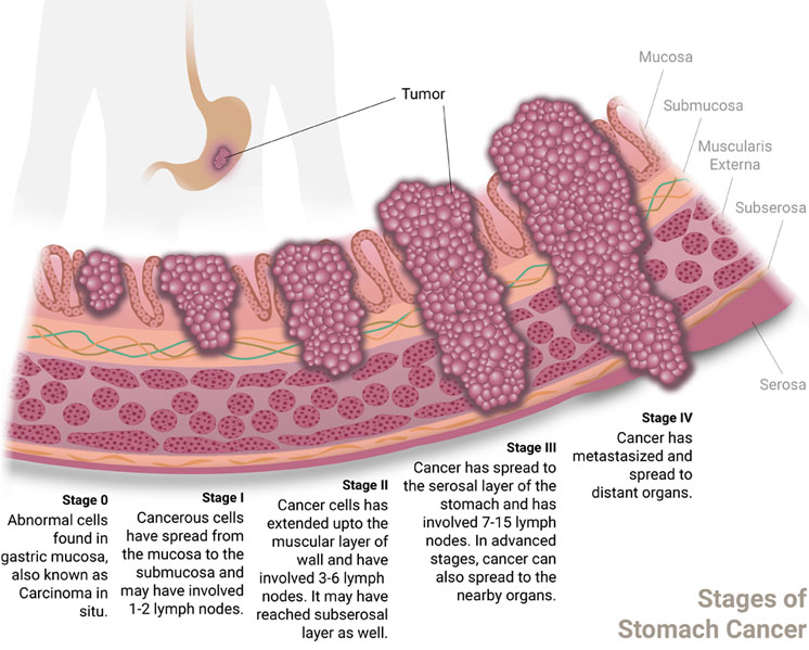 Stages of Stomach Cancer and their relevance to prognosis